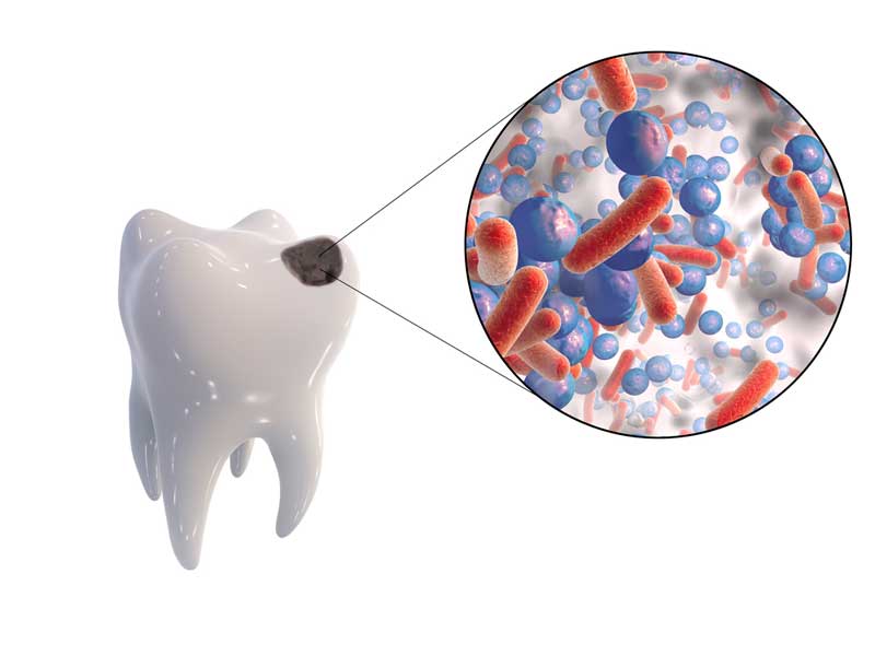 Бактерии кариеса могут спровоцировать болезнь Паркинсона