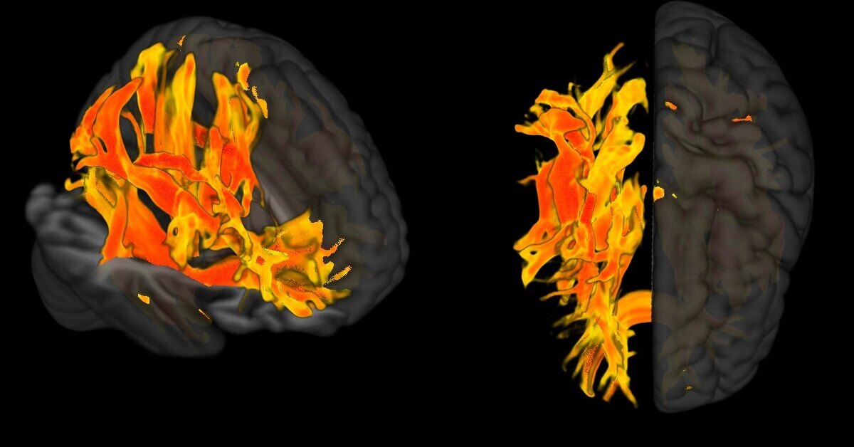 Высокое кровяное давление влияет на мозг раньше, чем считалось