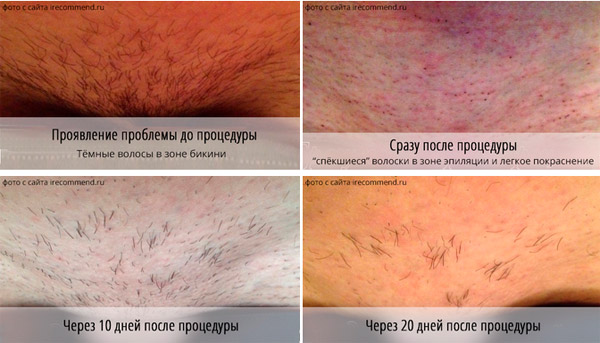 Как удалить волосы с ног и бикини в домашних условиях
