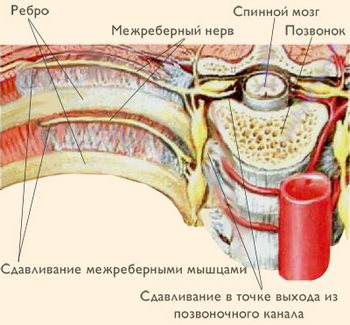 Межреберная невралгия: симптомы, причины, народные рецепты Болевые ощущения при приступе межреберной невралгии считаются одними из самых сильных по интенсивности.