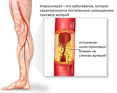 ВАЖНО! ТРЕВОЖНЫЕ СИМПТОМЫ АТЕРОСКЛЕРОЗА СОСУДОВ НОГ ВАЖНО! ТРЕВОЖНЫЕ СИМПТОМЫ АТЕРОСКЛЕРОЗА СОСУДОВ НОГ
