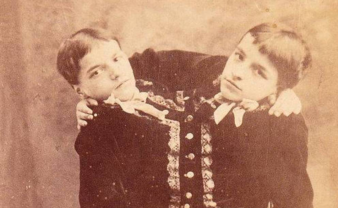 10 реальных историй сиамских близнецов
