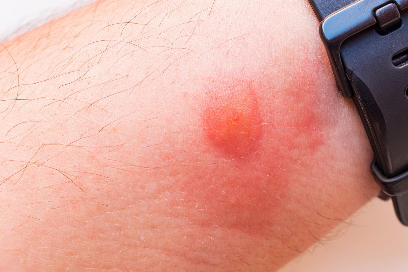 Аллерголог сообщил, в каком случае смерть от укуса пчелы наступит сразу