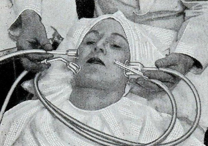 Высасыватель прыщей. То ли салон красоты, то ли пыточная: 18 причудливых изобретений прошлого для женской привлекательности