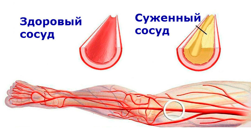 Чистые сосуды: 5 золотых рецептов от травника. Лечение атеросклероза