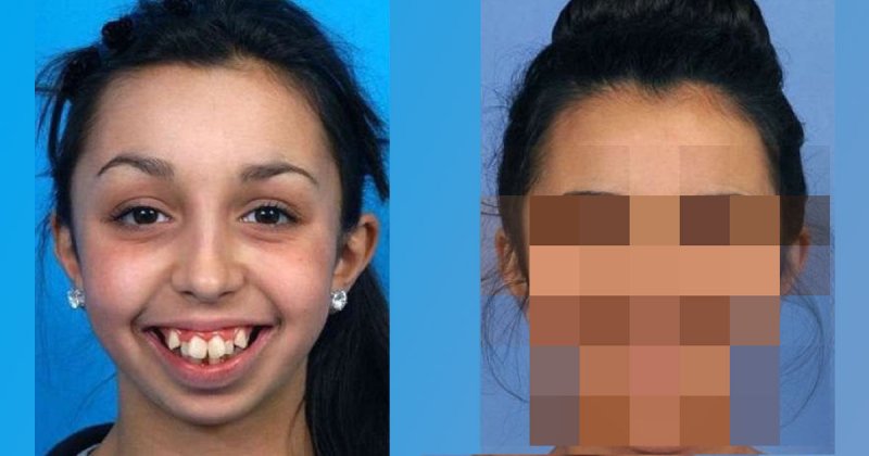 Хирург поправил ей форму челюсти: просто невероятное преображение зубы, красота, пластика, преображение, хирургия, челюсть