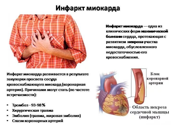 Первые признаки инфаркта миокарда у женщин и мужчин и первая помощь Первые признаки инфаркта миокарда у женщин и мужчин и первая помощь