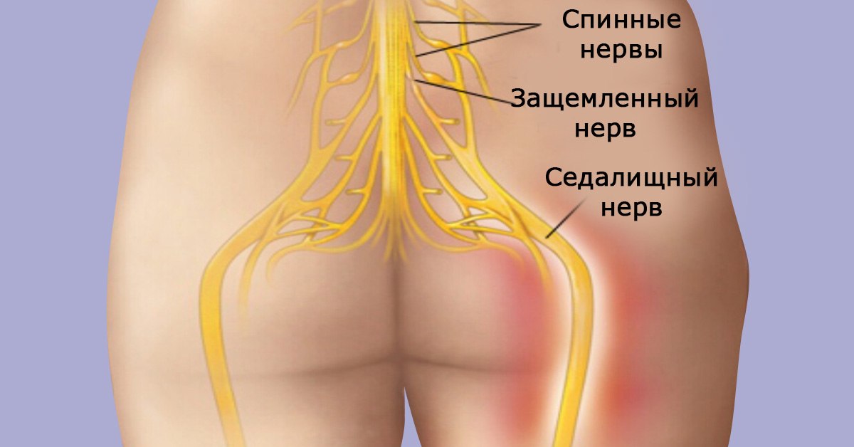 Как побороть радикулит лечение в домашних условиях