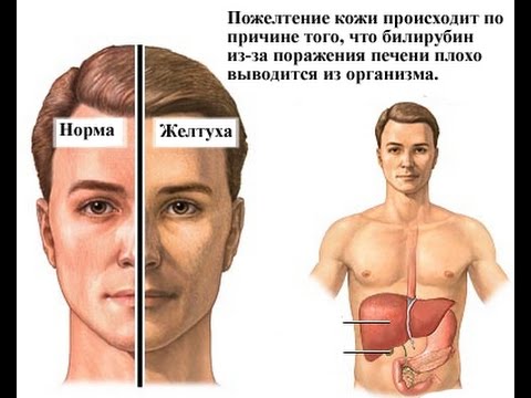 признаки проблем с печенью