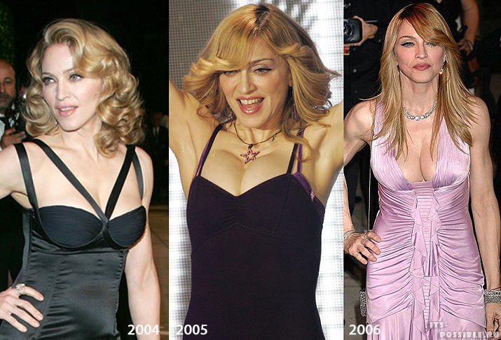 Madonna Plastic Surgery