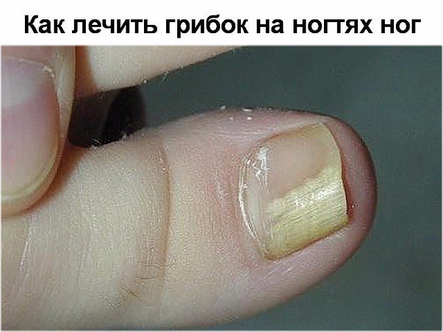 Как выглядит грибок на ногтях ног и как лечить Как выглядит грибок на ногтях ног и как лечить