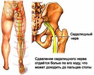 КАК УСТРАНИТЬ БОЛЬ В НОГЕ ОТ ВОСПАЛЕНИЯ СЕДАЛИЩНОГО НЕРВА Original