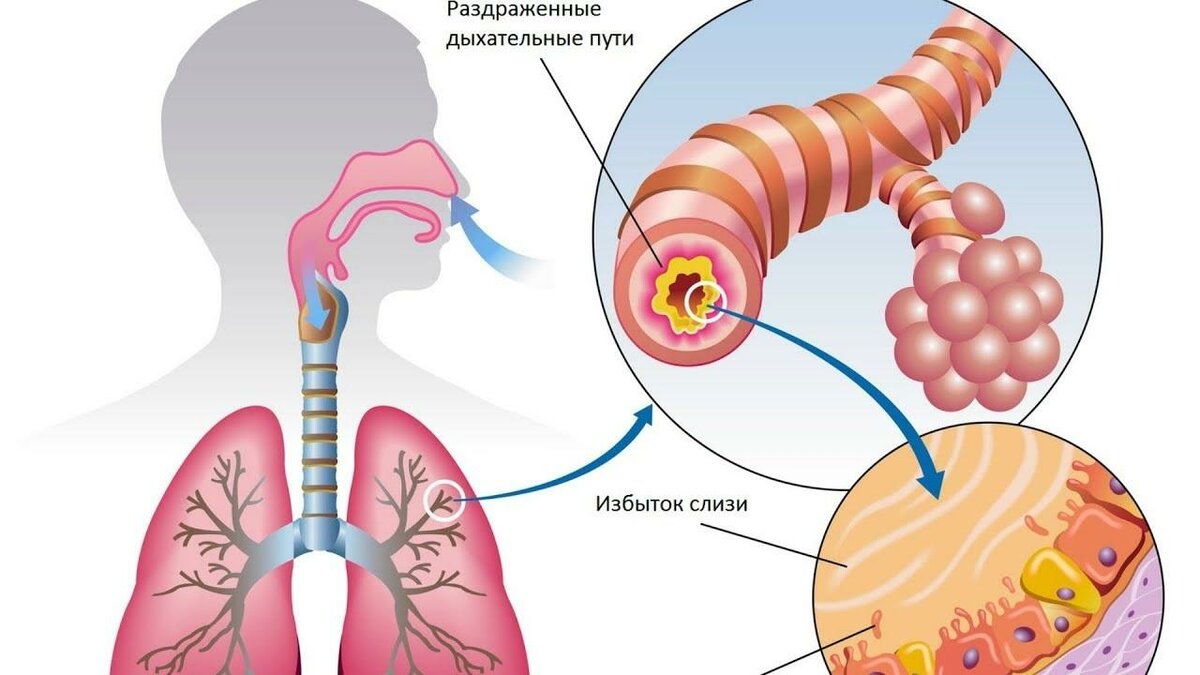 Мокрота в легких