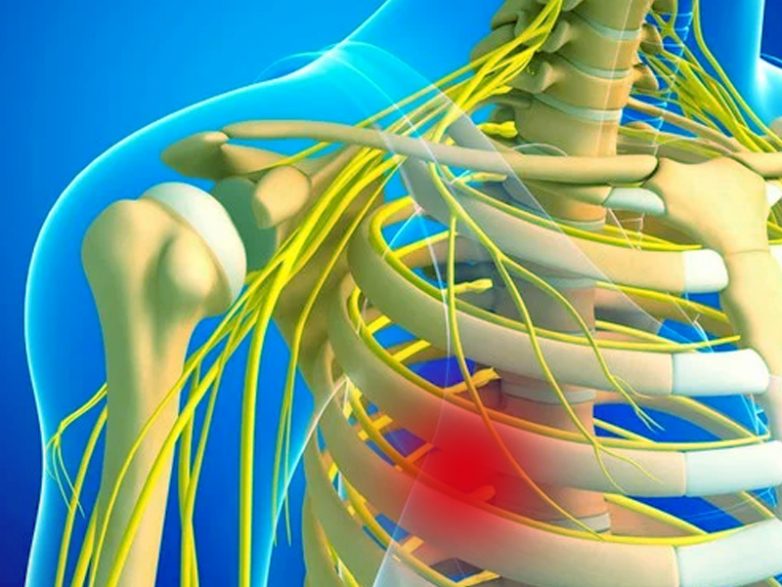 Как распознать межреберную невралгию