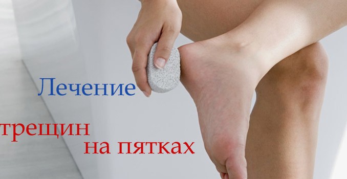 kak-vyilechit-treschiny-na-pyatkah