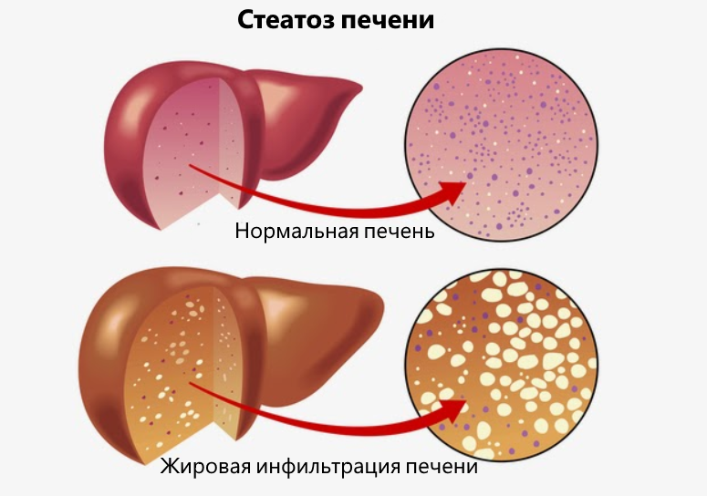 6 предупреждающих сигналов печени