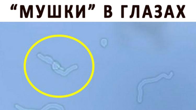 Откуда берутся «мушки» перед глазами?