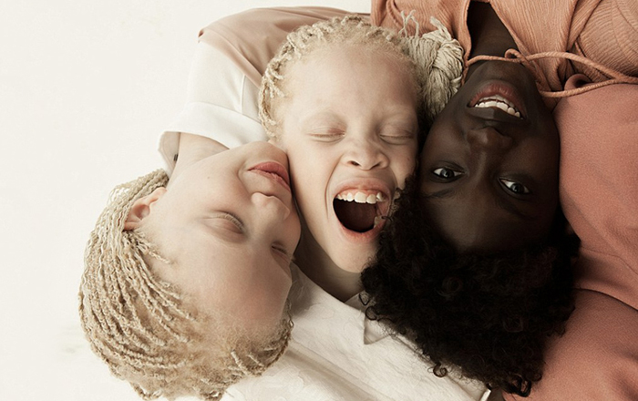Очаровательные близняшки-альбиносы покорили интернет своей уникальной красотой