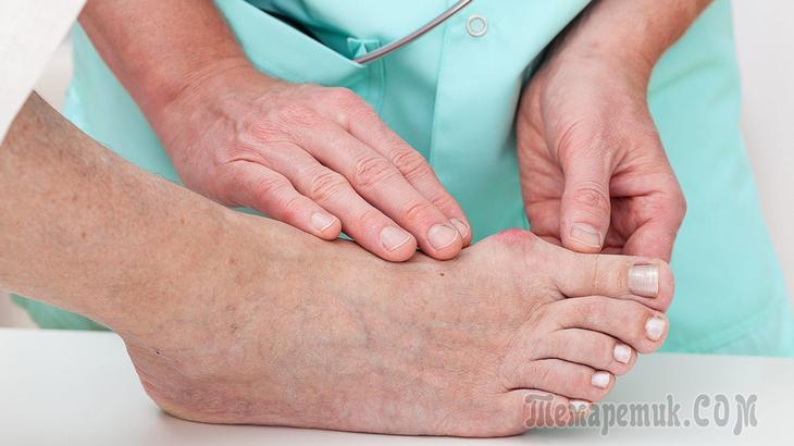 лечение косточки на ноге у большого пальца