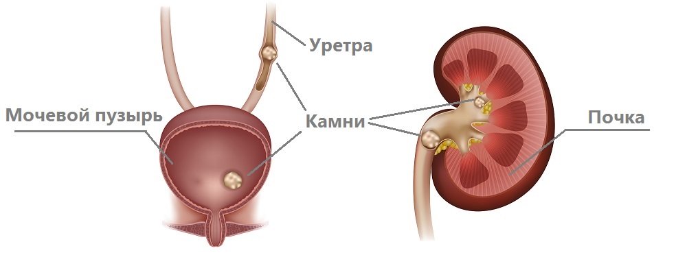 Камни в почках как лечить и чем 107