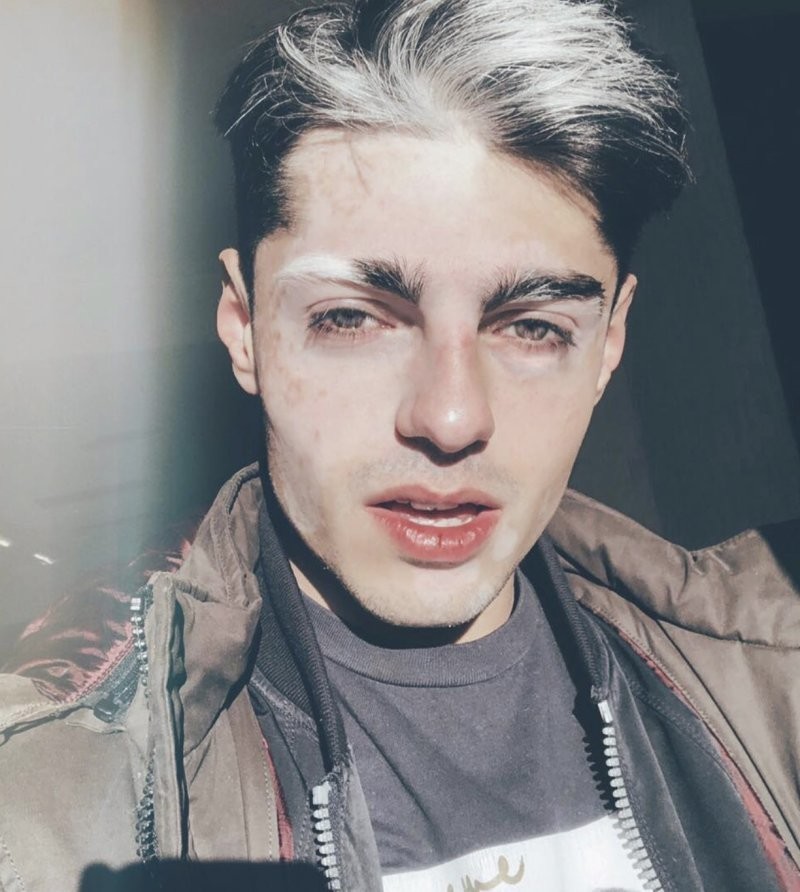 Белое пятно в медицине: история витилиго