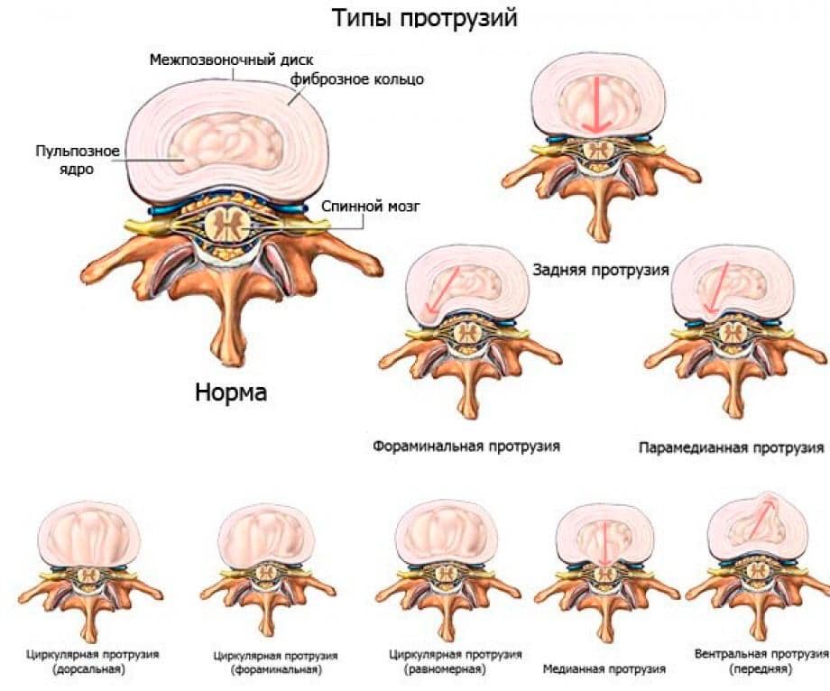 Диета При Грыжах Позвоночника И Протрузиях