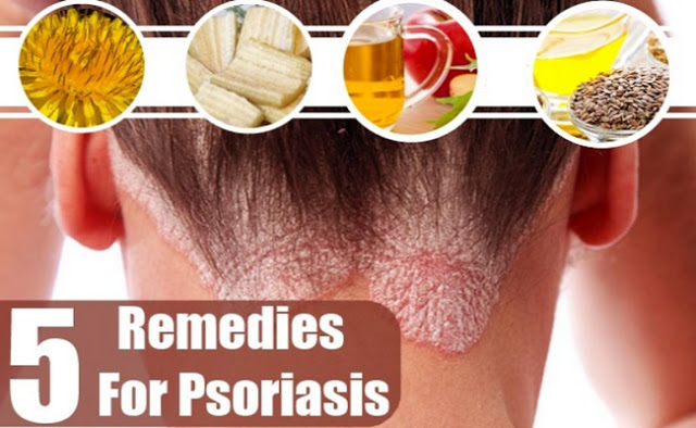 5 Powerful Natural Cures For Psoriasis