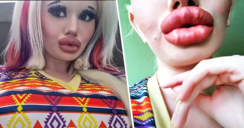 Тяга к прекрасному: болгарская студентка увеличивает губы и не может остановиться