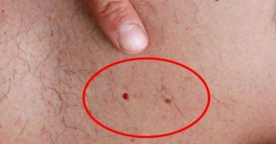 Если у вас есть эти две родинки, вы должны знать, что одна из них является потенциальным раком кожи! Если у вас есть эти две родинки, вы должны знать, что одна из них является потенциальным раком кожи!