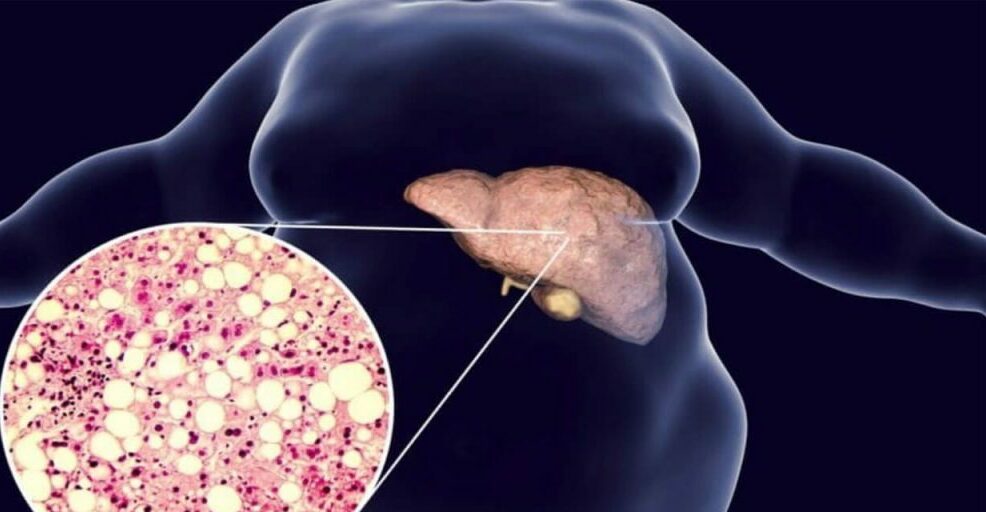 Диабет связан со значительно повышенным риском жировой дистрофии печени
