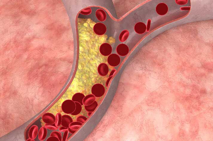 Circulation: гиперхолестеринемия вызывает очень высокий уровень холестерина