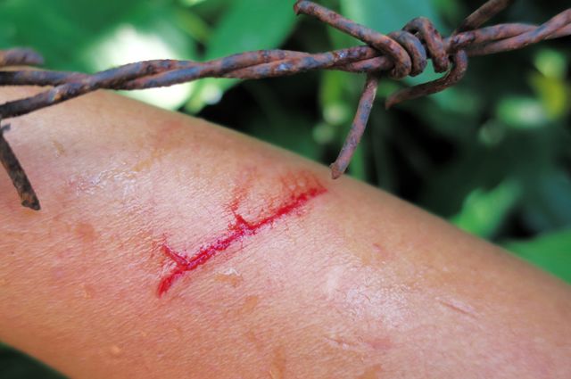 Как лечить порезы, проколы и другие летние раны