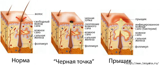 3925073_lechenieakneipostakne2 (643x266, 122Kb)