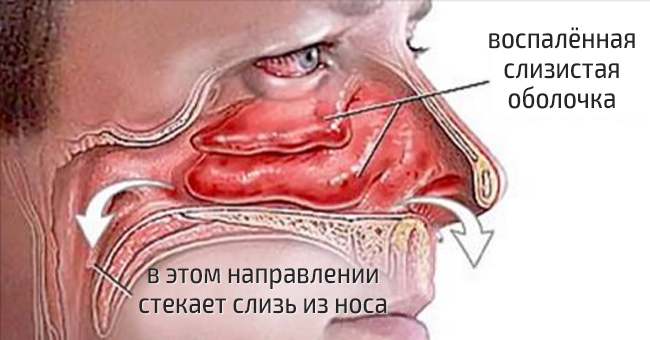 Как лечить нос и горло в домашних условиях