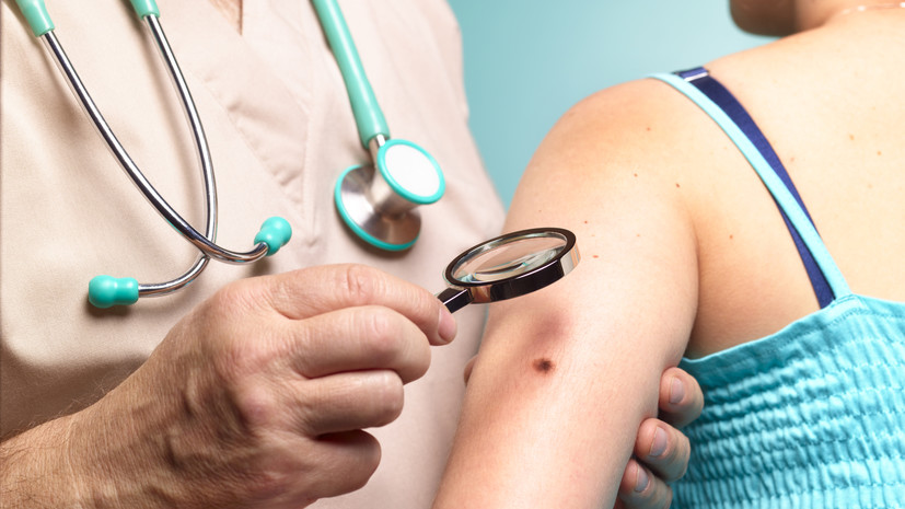 Врач Орлова: правило ABCDE помогает выявить меланому на ранней стадии