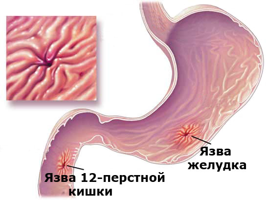 Народные средства лечения язвы двенадцатиперстной кишки
