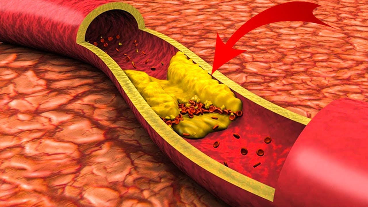 В чём разница между «плохим» и «хорошим» холестерином