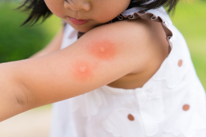 Как справиться с зудом после укуса комара за несколько секунд