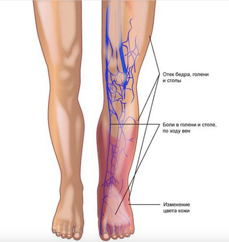 Как распознать варикоз и остановить болезнь на ранней стадии
