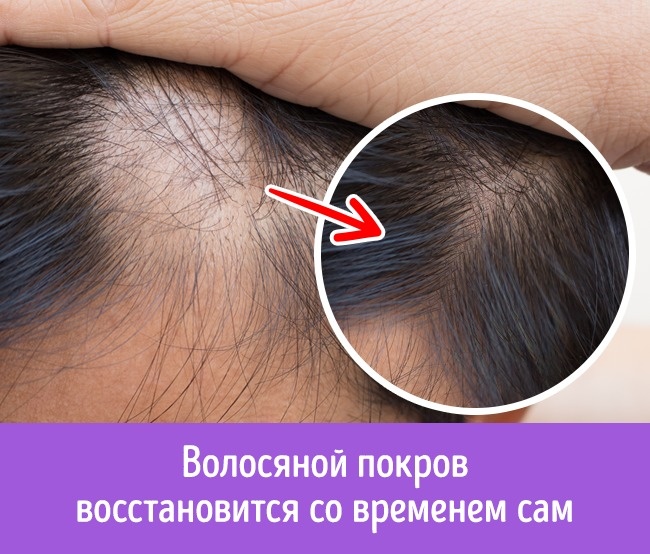 10 причин, почему выпадают волосы, и как это остановить 10 причин, почему выпадают волосы, и как это остановить