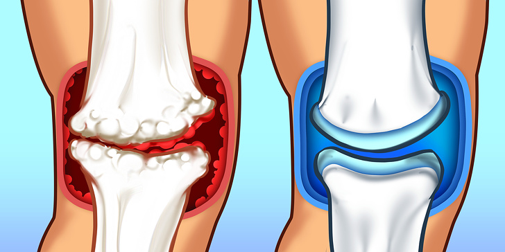15 продуктов, которые помогут справиться с болью в суставах