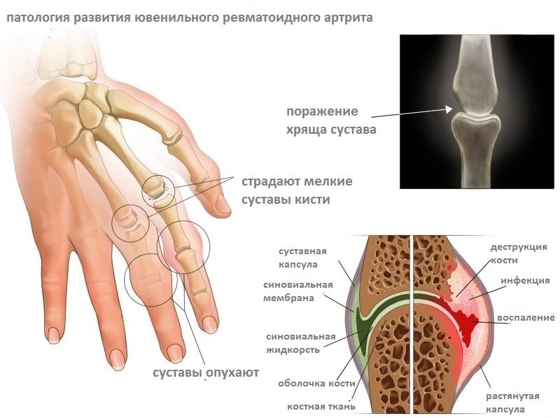 Артриты и артропатии Артриты и артропатии