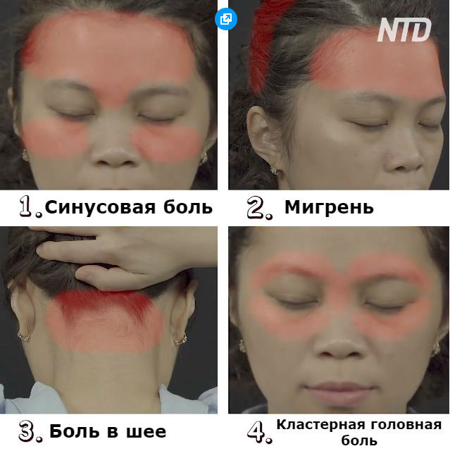 Китайцы считают, что есть 4 вида головной боли. Вот как избавиться от каждой из них Китайцы считают, что есть 4 вида головной боли. Вот как избавиться от каждой из них