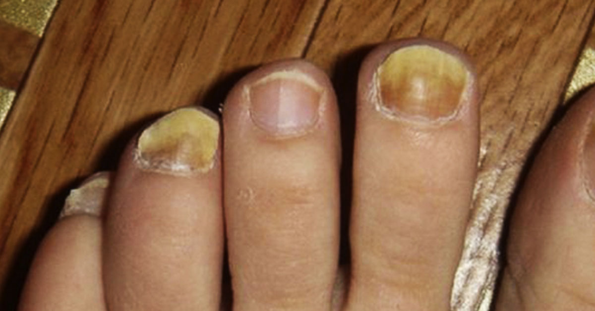 Домашние средства для лечения желтых ногтей с помощью 5 средств