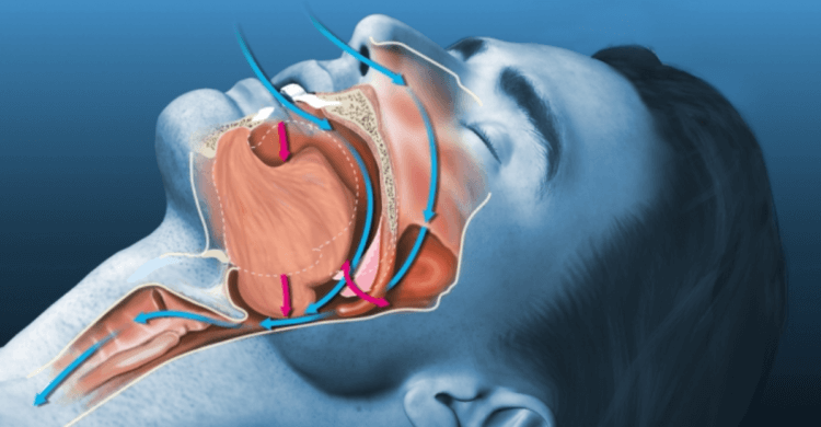 Почему люди храпят во сне. Храп возникает в результате вибрации в верхних дыхательных путях из-за потока воздуха. Источник изображения: remedium.ru. Фото.
