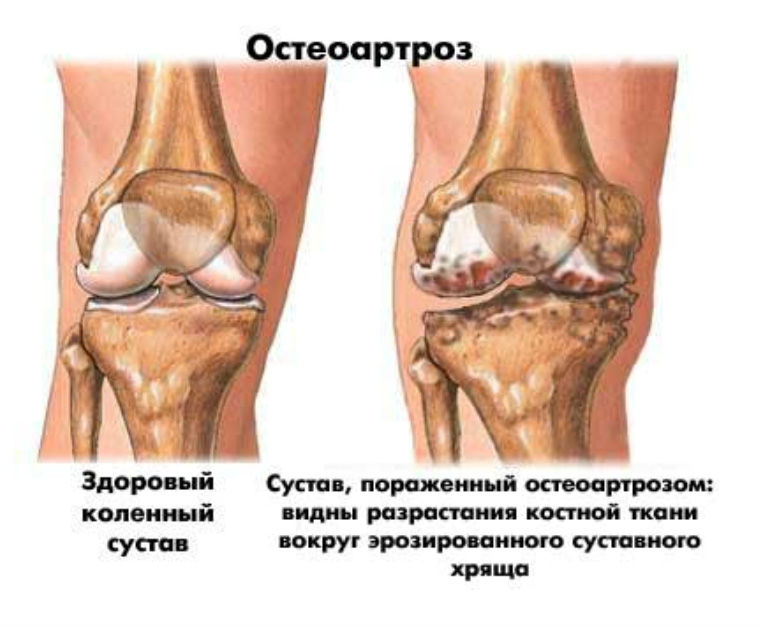 ÐšÐ°Ñ€Ñ‚Ð¸Ð½ÐºÐ¸ Ð¿Ð¾ Ð·Ð°Ð¿Ñ€Ð¾ÑÑƒ Ð±Ð¾Ð»ÑÑ‚ ÐºÐ¾Ð»ÐµÐ½Ð½Ñ‹Ðµ ÑÑƒÑÑ‚Ð°Ð²Ñ‹