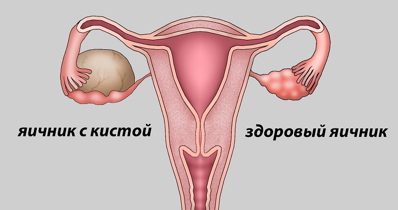 диагнозы в гинекологии
