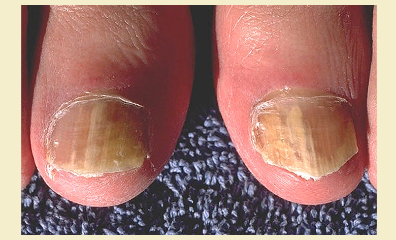  грибок ногтей пальцев ног
