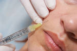 Использование гелей, состоящих из гиалуроновой кислоты, для увеличения губ и коррекции носогубных складок (из ранее опубликованного)