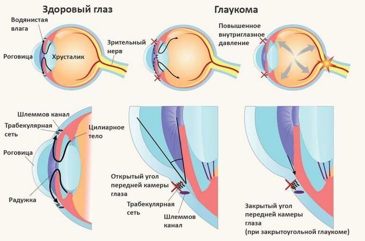 ГЛАУКОМА: НАТУРАЛЬНЫЕ СРЕДСТВА, КОТОРЫЕ ПОМОГУТ ОБЛЕГЧИТЬ СОСТОЯНИЕ... Original